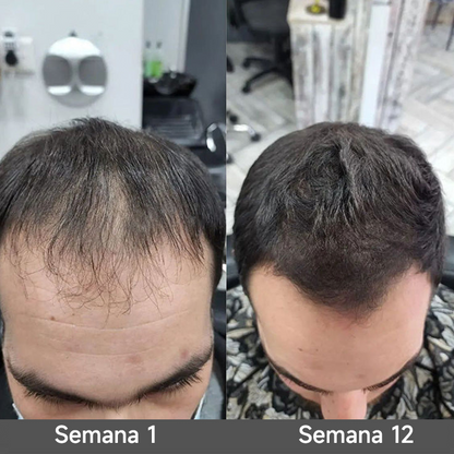 🌿👨‍⚕️ Tienda oficial en EE. UU. 🇺🇸 | 🔥 Champú y acondicionador 2 en 1 PURELORA® de cebolla y romero con complejo activo 15X para el crecimiento capilar: para un cabello con apariencia más gruesa, abundante y fuerte.